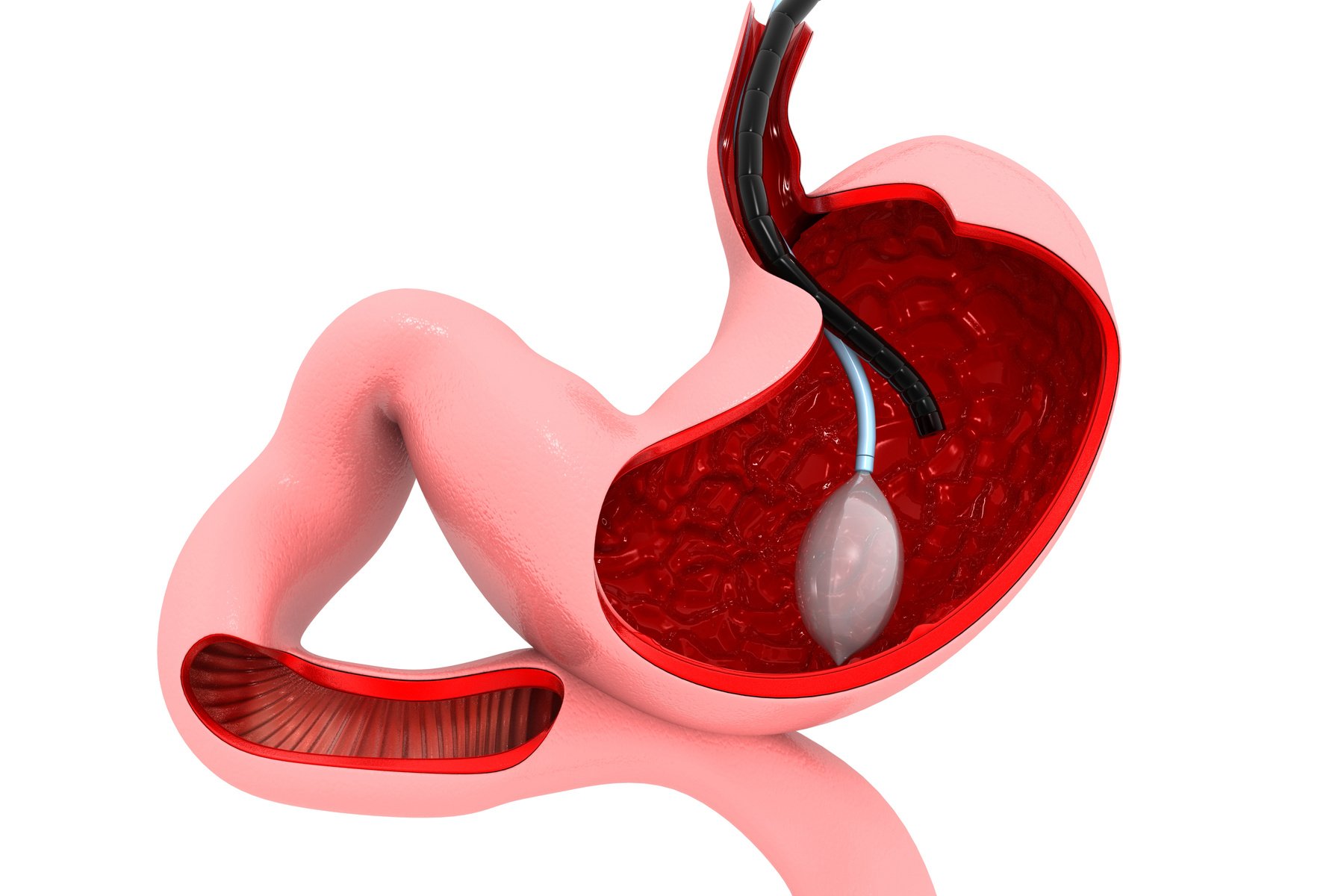 stomach Endoscopy. Gastric Ballon Inside a Stomach